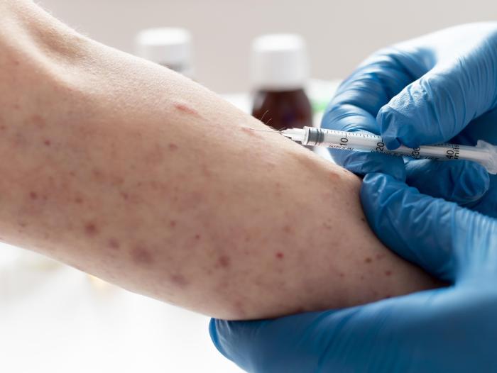 Waspada Campak Jelang Libur Lebaran Imunisasi dan PHBS Jadi Perlindungan Utama